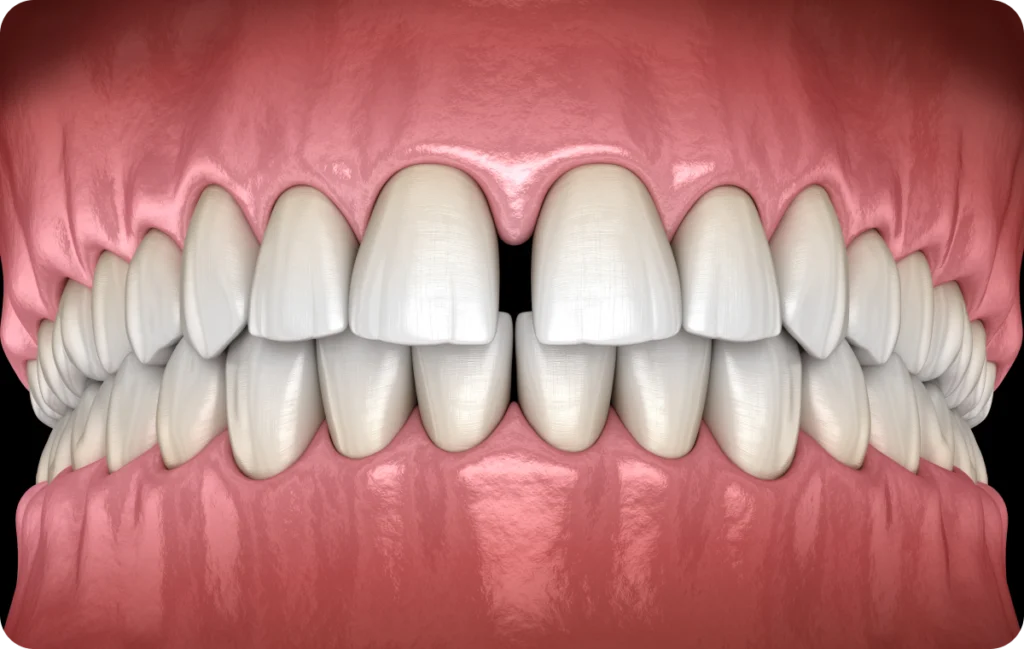 Dents écartées