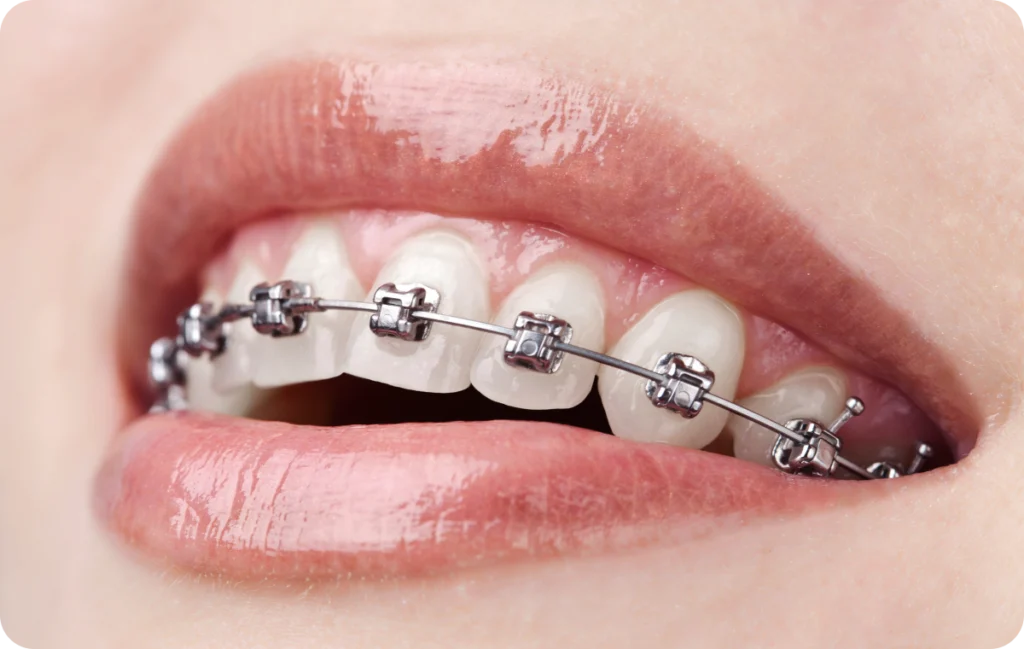 Dents écartées